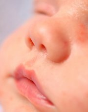 L'eczéma chez le nourrisson | Nestlé Health Science