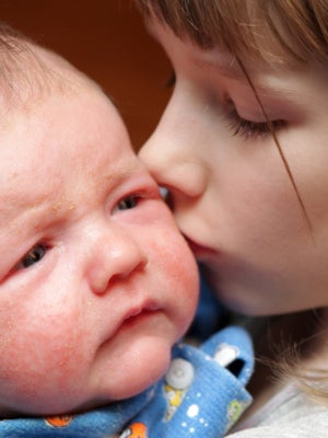 Croute de lait et eczéma bébé sont-ils liés ?